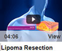 Lipoma Resection